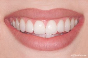 close up photo after improved smile