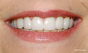 close up of a woman after dental treatment