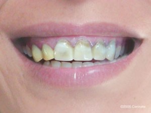 close up of a woman who needs dental treatment