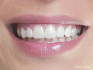 close up of a woman with her new teeth