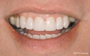 After photo with new teeth