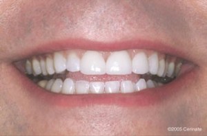 close up of a man after dental treatment