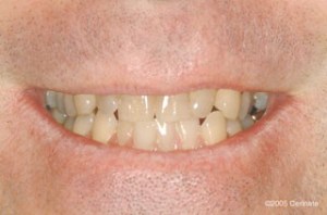 close up of teeth before dental procedure