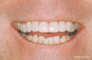 close up of teeth after dental procedure