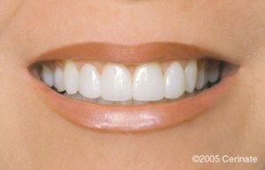 close up of a woman after dental procedure