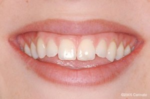 close up photo before improved smile